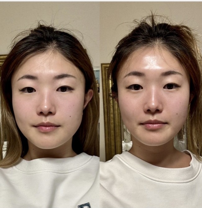小顔矯正・美顔骨で目指す、すっきりとした印象